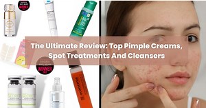 Best Pimple Cream in Singapore and More Acne Fixes!