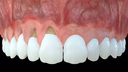 Tunneling Technique #Dentistry #LearningTips #BitesnBraces #smile #medical #People #dentista #Tooth #Implant #Dental #dentist | Bites & Braces Dental