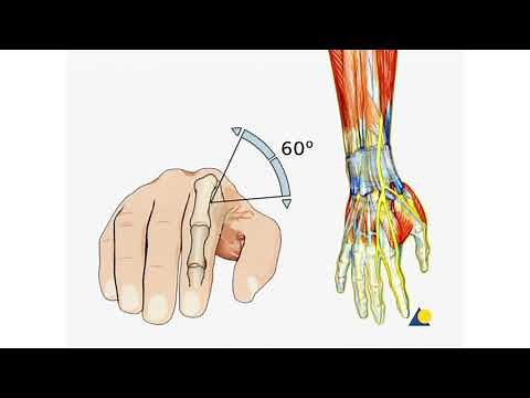 AO Distal radius joint spanning external fixator