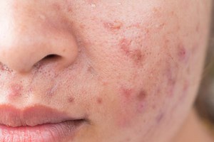 Acne Scars | Dermatology and Laser Centre of Los Angeles