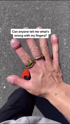 Ever seen fingers like this? 👀 Clubbed fingers happen when the tips of the fingers enlarge and the nails become extremely curved from front to back. This can be a symptom of disease, often of the heart or lungs which cause chronically low blood levels of oxygen. Diseases which cause malabsorption, such as cystic fibrosis or celiac disease can also cause clubbing. #TheMoreYouKnow #ClubbedFingers