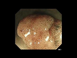 Cromoendoscopia digital: Clasificación de JNET