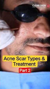 TCA Cross Treatment For Ice Pick Scars Explained! (Part 2) | Clear Skin Clinic, Pune