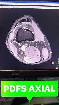 MRI KNEE PLANNING #anatomy