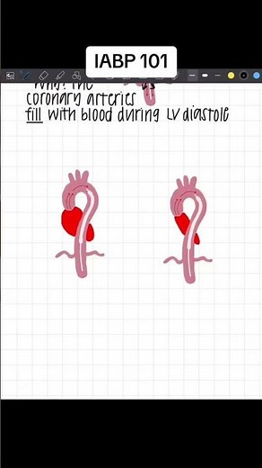 Intra Aortic Balloon Pump (IABP) and Counterpulsation. How it works!