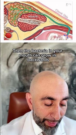 What causes recurrent parotitis? #parotid #parotidgland