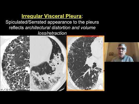 Consolidation and Ground Glass - Imaging Approach to Fibrosis