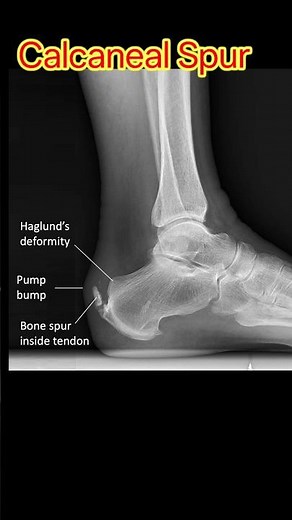 Calcaneal Spur | Calcaneal X-ray #calcanealspur #spur #anklexray #radiology #shorts #aiims