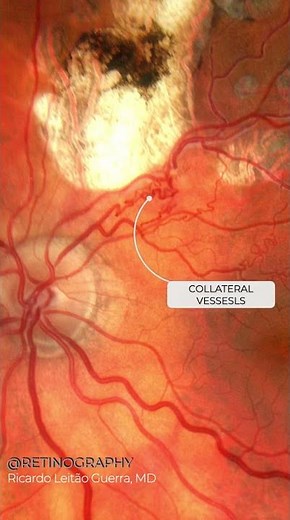 BRVO treated with laser photocoagulation