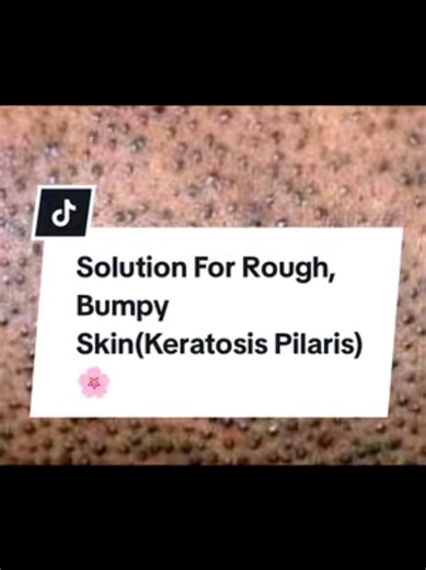 Effective Body Lotions for Keratosis Pilaris Treatment