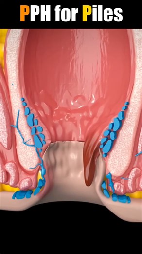 3D Animation of the PPH Procedure for Fourth-Stage #doctor #documentaryphotography #DoctorWho #reel # shorts #DoctorWh#doctor | SMART Doctor