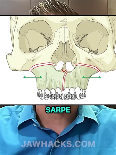 Ronald Ead on Instagram: "MARPE failure rates are so low that SARPE's invasive surgical approach is no longer justified. SARPE pushes from the bottom of teeth, risking segments tipping outward rather than translating properly. Surgical cuts limit expansion to the nasal cavity floor, so you don't get meaningful nasal opening, airway improvement, or cheekbone widening."
