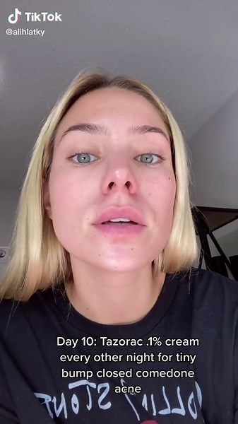 Improving Skin Texture with Tazorac Cream: A Hyram-Approved Acne Solution