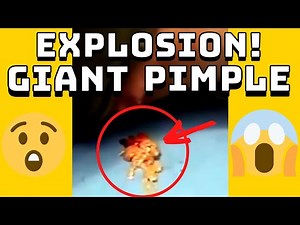 Giant Pimple Explosion Cyst Popping | Acne Pus Blackheads Bursting | ASMR Satisfying 32# 😱😱