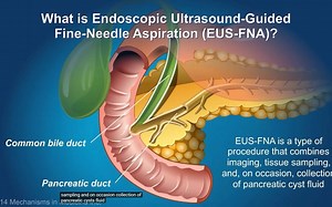 Understanding EUS-FNA
