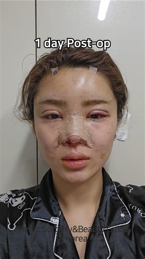 An extremely high-difficulty eye and nose surgery… what’s the result? #shorts #fyp #glowup #korea