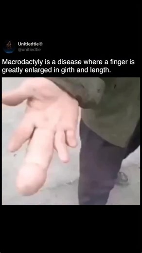 Unitiedtie Spooky ® | Ties this is one of those conditions you rarely hear about until you see it. Macrodactyly is a rare condition where a finger or toe grows... | Instagram