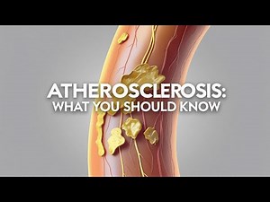 Atherosclerosis Explained | Causes, Symptoms, Treatment & Prevention