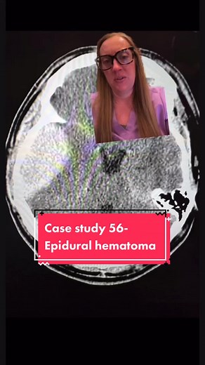 Understanding Epidural Hematoma: Symptoms, Treatment, and Differences from Subdural Hematoma