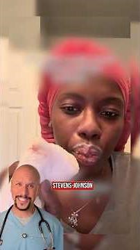 Are you higher risk for Stevens Johnson Syndrome?🫣