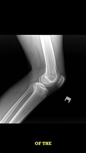 Knee X-ray Short: Normal or Not?