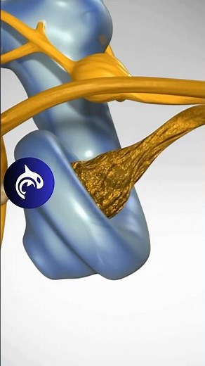 See how Hearing Loss from Nerve Degeneration works in 3D Animation.