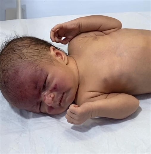 In this video, we share the progress of a baby with Epidermolysis Bullosa (EB). The skin lesions and blisters are now healing and getting better with careful management, daily dressings, and supportive care. 💡 Epidermolysis Bullosa is a rare genetic skin condition where even minor friction causes blisters and wounds. With proper wound care, nutrition, and infection prevention, the child’s condition can improve significantly. 👶 Watch the journey of this baby’s recovery and healing. #Epidermolys