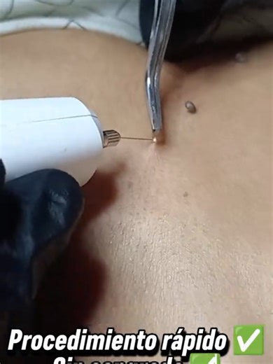 Los acrocordones son lesiones benignas muy comunes en cuello, axilas o párpados. En este caso realizamos la extracción de 3 acrocordones de forma rápida, segura y sin sangrado. ⚠️ No intentes retirarlos en casa. Agenda tu evaluación médica. 📍Av.Angamos Este 260-Miraflores 📲 Escríbenos por WhatsApp - 946 737 305 #Acrocordones #Dermatología #ProcedimientoSeguro #LesionesBenignas #MedicinaEstética