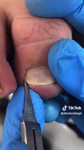 Pedicures #fyp #fypシ #ingrowntoenail #pedicure #foryou