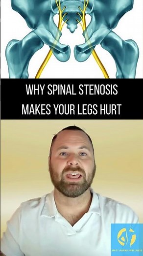 Why Spinal Stenosis Makes Your Legs Hurt #backpainrelief #mobility #painrehabb