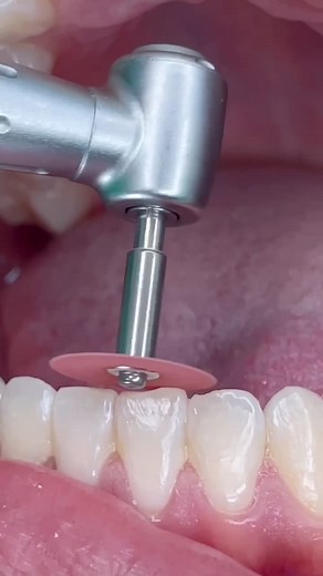 Orthodontic Tips and Tricks for Perfect Teeth!