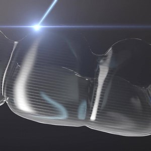 Did you know that many practices offer affordable payment plans for Invisalign treatment? Visit the doctor locator tool on our website and request an appointment to get started. _ Invisalign® treatment is a series of clear plastic removable orthodontic aligners that gently move patients’ teeth. An orthodontist or Invisalign trained dentist will be able to advise whether Invisalign treatment is right for you. You should always read and follow their directions for use. In rare cases, allergies may