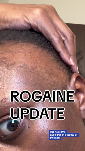 Alopecia Update: ROGAINE Growing Hair Treatment for Black Women