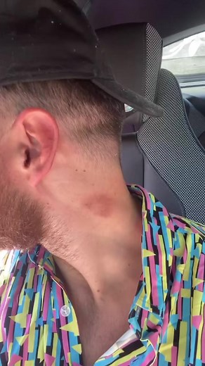 8.6K views · 82 reactions | Fake hickey prank | Kristenhanby | Facebook