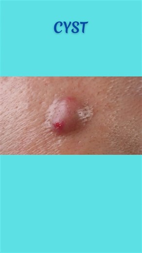 What is INSIDE the CYST? #cyst #abscess #cystpoping