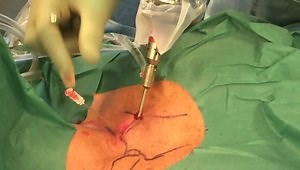 Arthroscopic Excision of the Sternoclavicular Joint