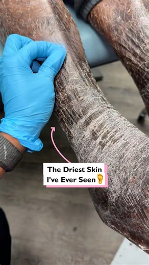 My skin is so dry! 😲 #fblifestyle #dryskin #skincare | Four Nine