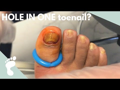 HOLE IN TOENAIL?! | Fungal Toenail Removal