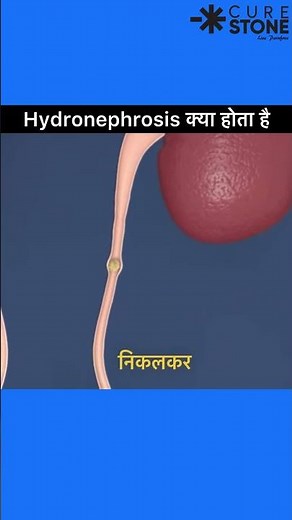 What is hydronephrosis | How kidney swelling happens | rirs |