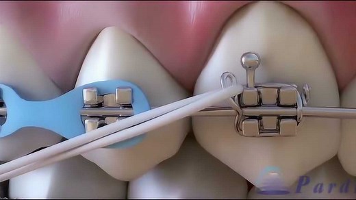 任欢医生告诉你——牙齿矫正过程中牙齿是如何移动的！