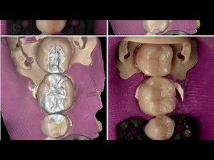 Let’s talk about Inlay and Onlay tooth preps and review some of my preps.