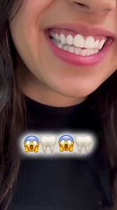 238K views · 214 reactions | Invisible teeth braces offer a discreet way to align teeth. Learn how they work, the process involved, and what to expect. Explore more to get the details. | Bypassers | Facebook