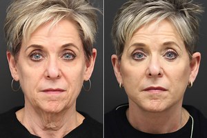 Facelift New Jersey for a Smoother, Younger Look