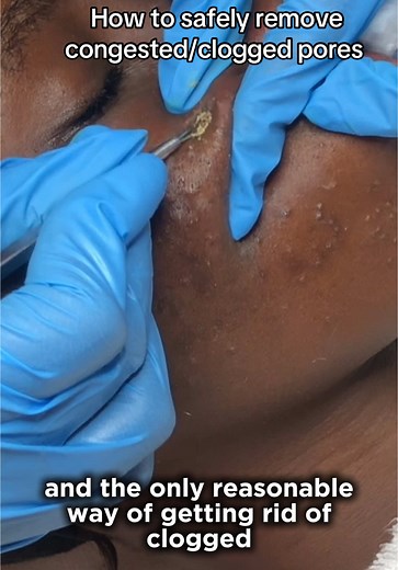 A deep pore cleansing facial Congested pores are a common skin issue that can make the complexion look dull, bumpy, or uneven. When pores become clogged with excess oil, dead skin cells, dirt, and other impurities, they can lead to blackheads, whiteheads, and even acne breakouts. Pore congestion often occurs on areas like the T-zone (forehead, nose, and chin), where oil glands are more active. There are several causes of congested pores, including oily skin, lack of exfoliation, makeup buildup,