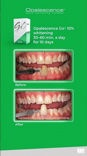 Opalescence Go™ | Case 4