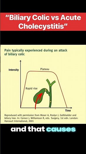 Understanding Biliary Colic and Acute Cholecystitis