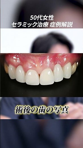 歯が割れて無くなっても大丈夫ですか？50代女性の悩みをセラミック治療で解決【セラミック症例解説】