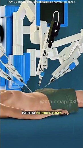 Robotic partial nephrectomy surgery (3D animation) #drone #theflash #space #automobile #robolution