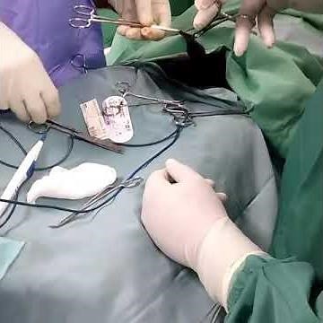 Le Deroulement de la circoncision au bloc Opératoire