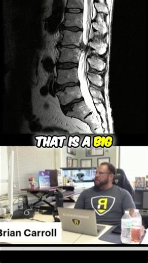 Massive disc bulge MRI case study! #lowbackpain #discherniation #discbulge #casestudy #backpain